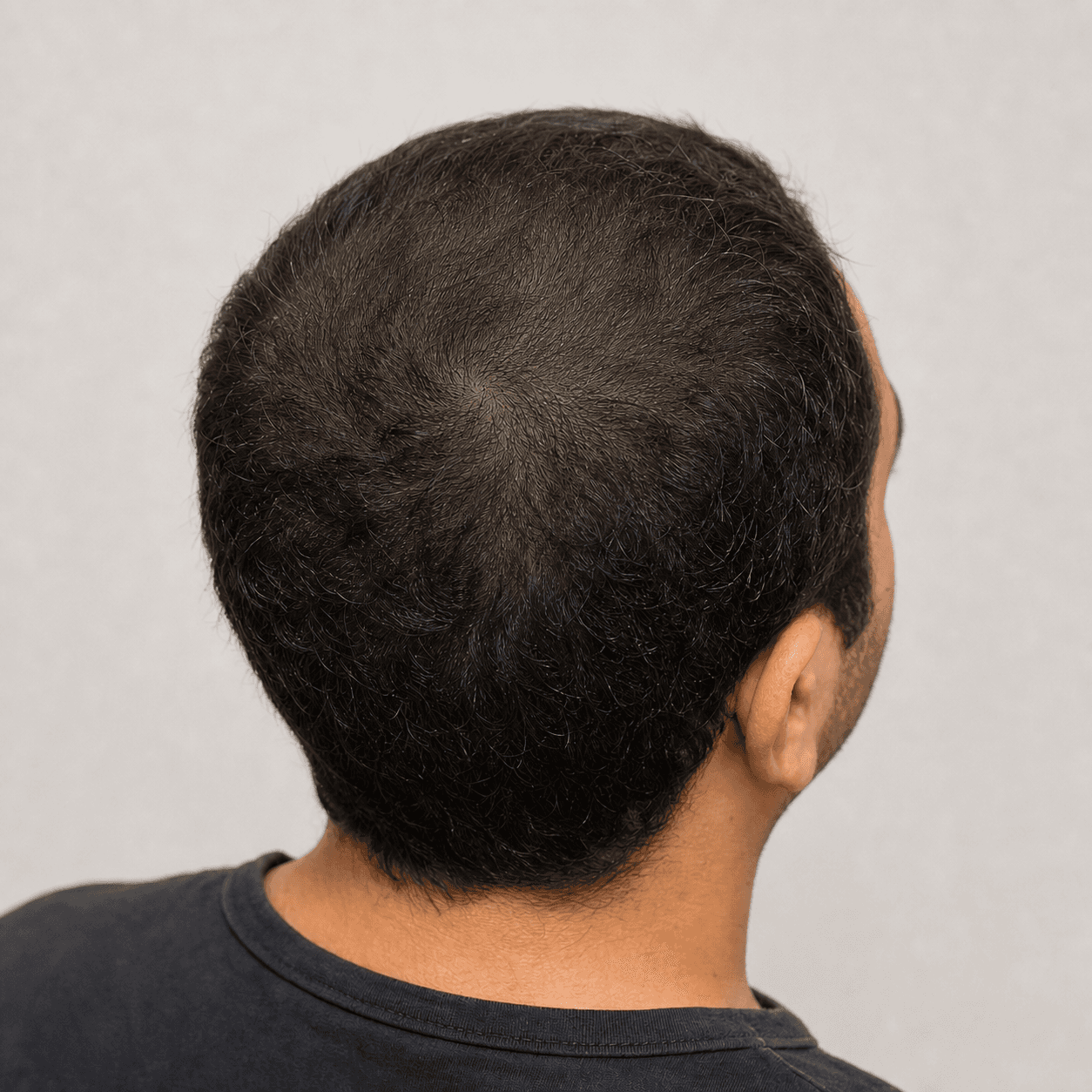 مقایسه شبیهسازیشده تغییر ملایم تراکم مو در ناحیه تاج سر، نمای بعد